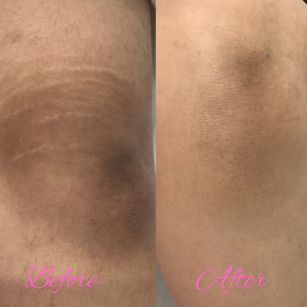 My knees don't stress me out anymore